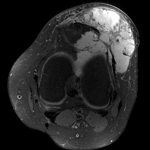 Figure 4 for case synovial sarcoma ( RID4558 )